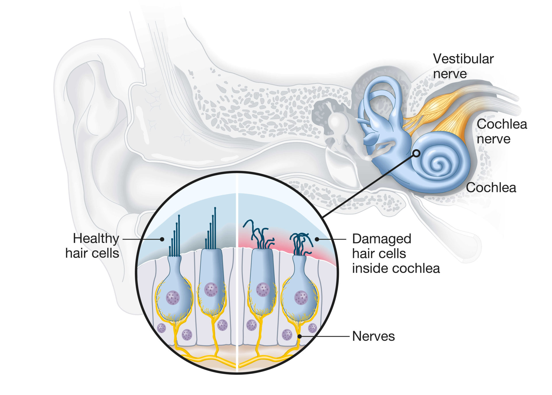 diagram of damaged hair cells within the cochlea in comparison to healthy hair cells