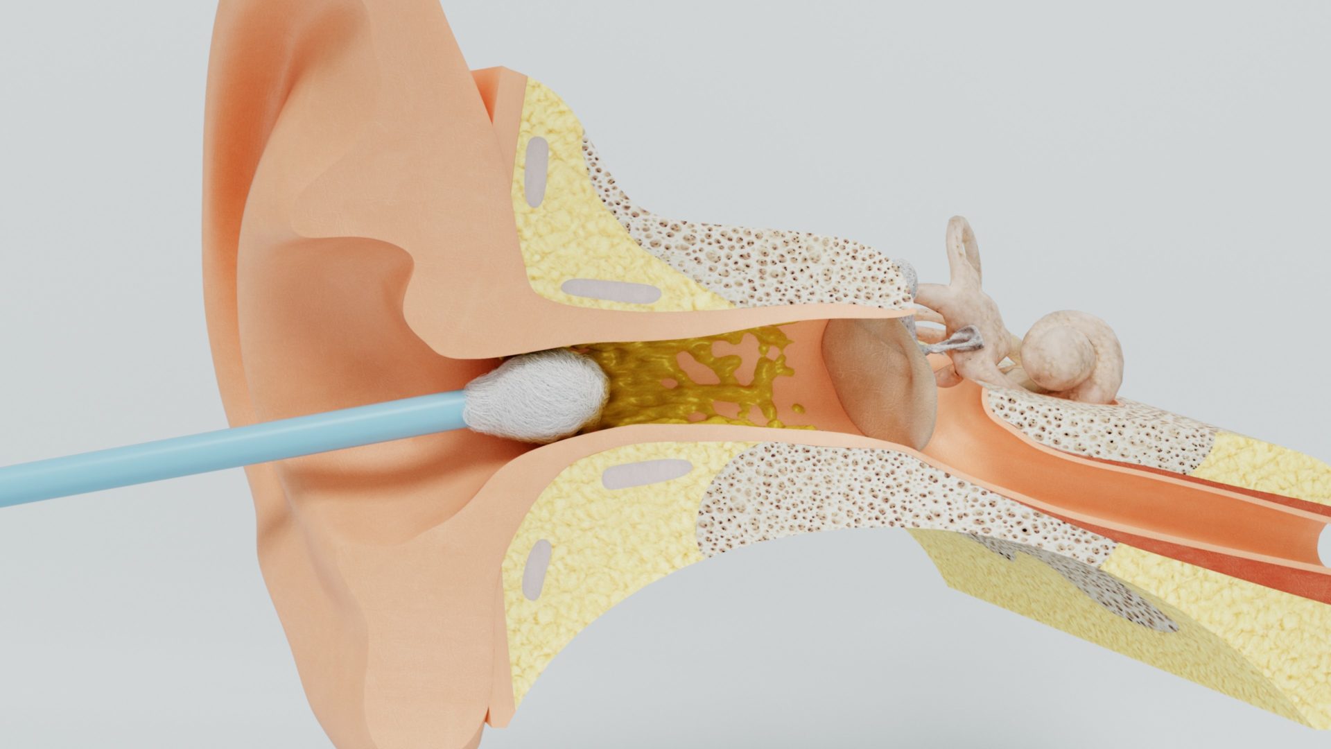 ear canal showing ear wax buildup