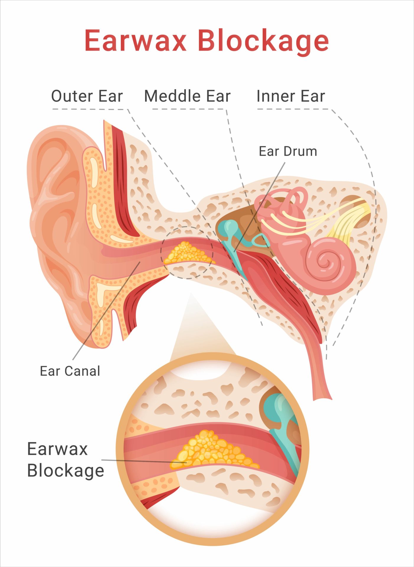 in-depth diagram of the ear and where ear wax is positioned