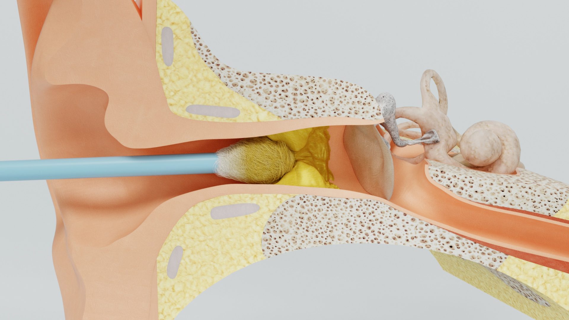 earwax blockage caused by cotton swab