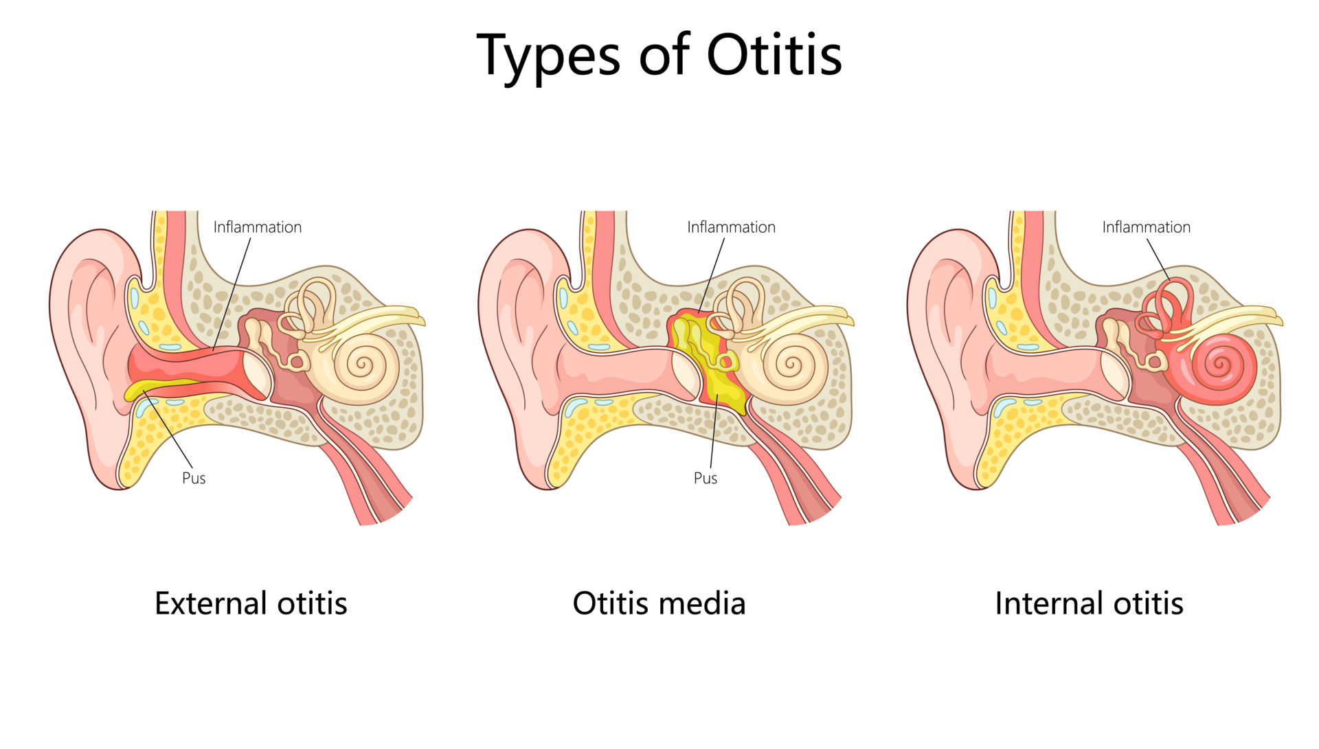 Drawn diagrams of types of ear infections